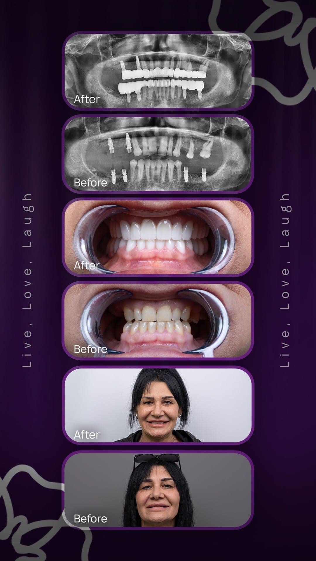 Dental Implant result 5