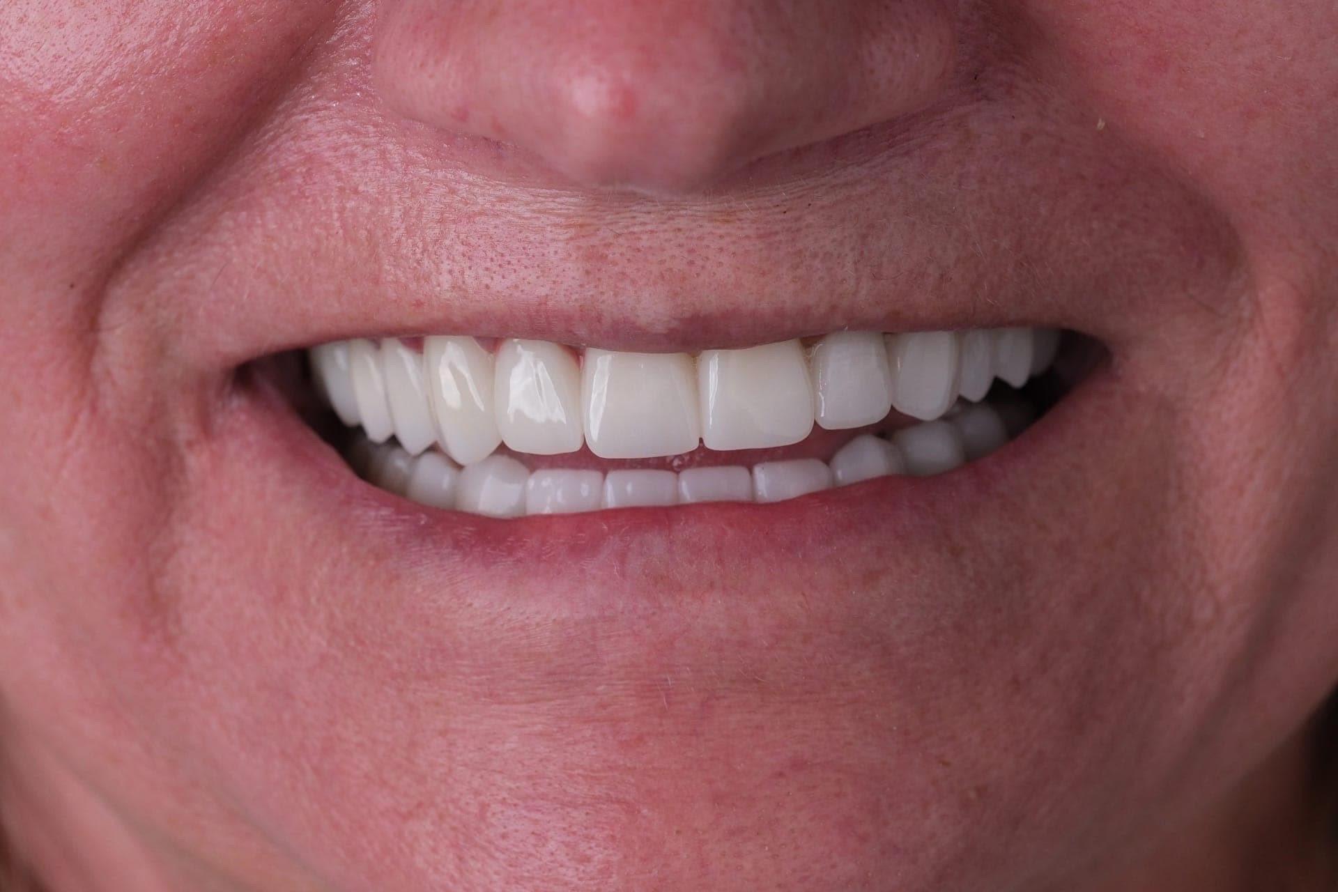 Zirconium Veneer result 2