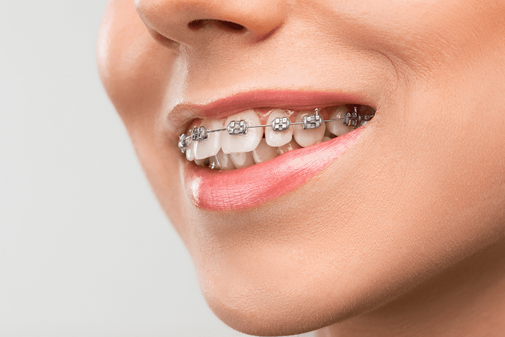 Orthodontic 1 Aura Smile Studio Orthodontics Aura Smile Studio