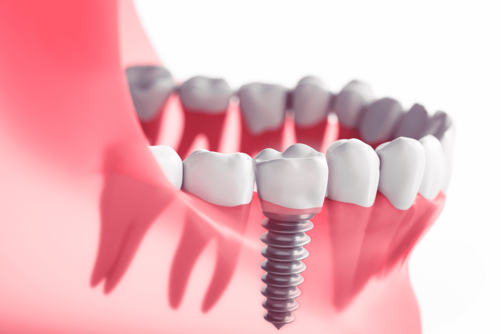 Dental Implants 1 Aura Smile Studio dentalimplats Aura Smile Studio