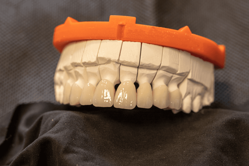 Zirkonkronen 1 Aura Smile Studio Zirkonium Aura Smile Studio